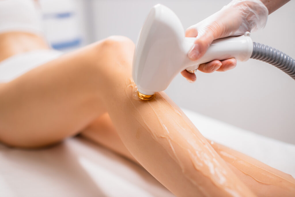 Laser hair removal